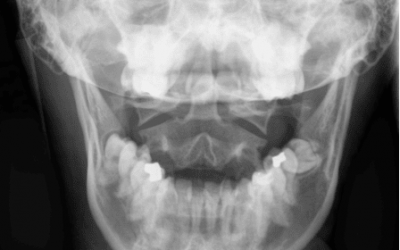 The Role of the Upper Cervical Spine in Meniere’s Disease